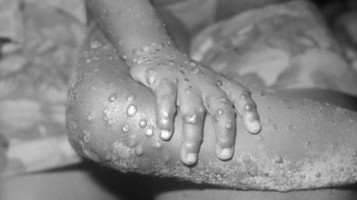 monkeypox-845x475-1